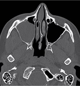 Computed tomography scan of the nasal sinuses: right-sided sinusitis