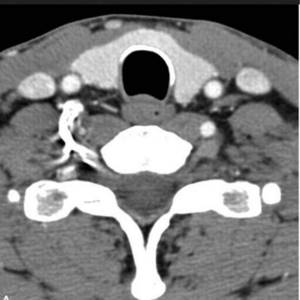 Computer tomogram of the thyroid gland