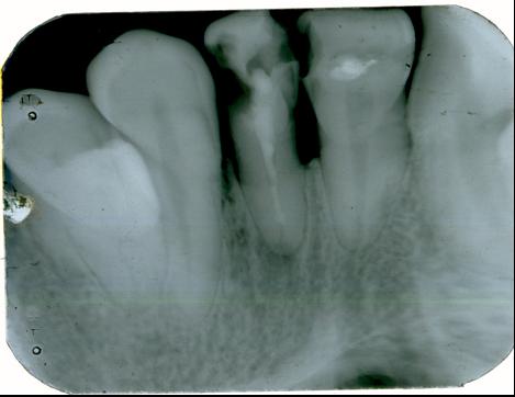 Computer intraoral radiography (visiography) with a reduced level of radiation exposure