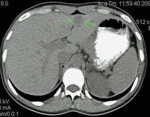 Computed tomograms of FNH of the liver in patient G: native phase, in the CII-III projection of the left lobe of the liver a focal formation of low density is determined, with a fairly dense contour, dimensions 27 x 15 mm