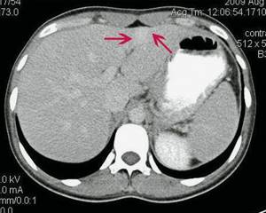 Computed tomograms of FNH of the liver in patient G: excretory phase, in the delayed phase there is a slow washout of contrast