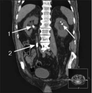 Stones in the pyelocaliceal system and ureter identified on CT (indicated by arrows)
