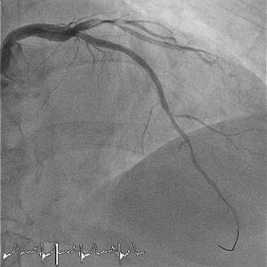Coronary angiography left coronary artery