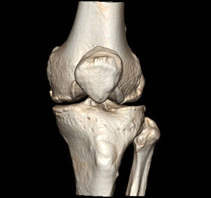 CT scan of the knee in Kyiv