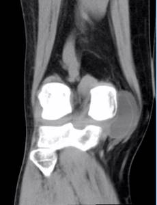 CT scan of the knee joint with contrast