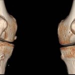 CT scan of the knee joints - photography