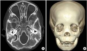 CT scan of the child&#39;s facial skull