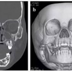 CT scan of the facial skull with 3D reconstruction