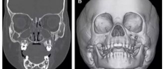 КТ лицевого черепа с 3D-реконструкцией