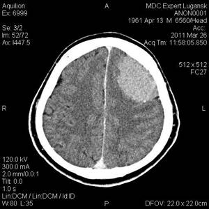 CT meningioma.jpg