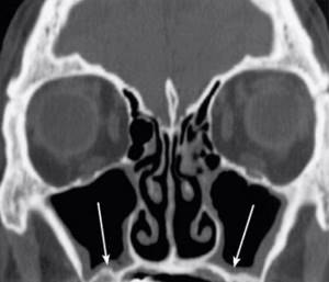 CT scan of the nasal sinuses (frontal section). Arrows indicate thickening of the mucous membranes 