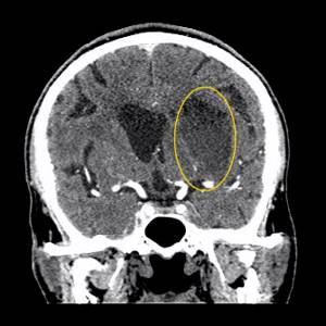 CT tumor 2.jpg