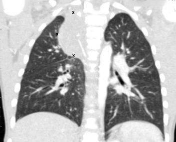 CT scan of the chest demonstrates a mediastinal tumor (the boundaries are highlighted with markers)