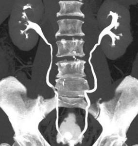CT scan of the urinary system with enhancement