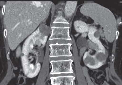 CT papillary cell carcinoma.jpg
