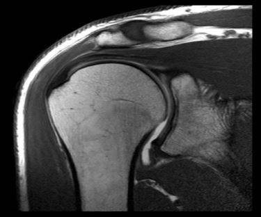 CT scan of the shoulder joint
