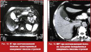 CT scan for cholelithiasis
