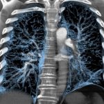 What does CT scan of the mediastinum show?