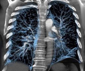 What does CT scan of the mediastinum show?