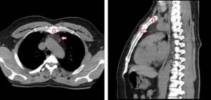 CT scan of the mediastinum. Red arrows indicate lipoma. 