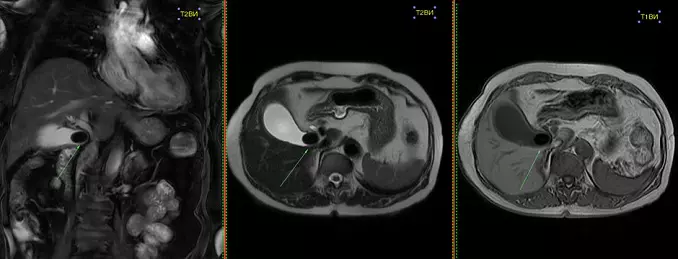 CT gallbladder