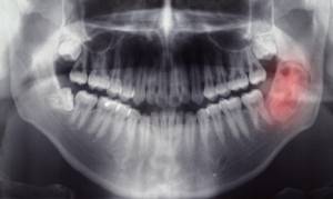 treatment of tooth root granuloma