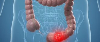 Treatment and diagnosis of colon cancer