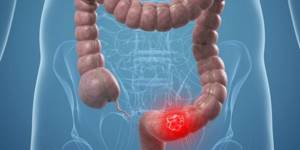 Treatment and diagnosis of colon cancer