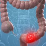 Лечение и диагностика рака кишечника