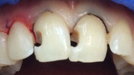 Treatment of caries between the front teeth