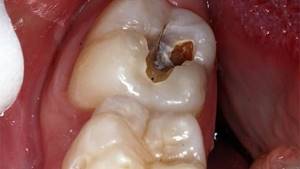 Treatment of wisdom tooth caries if it hurts