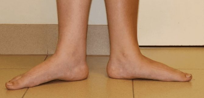 Treatment of flat feet