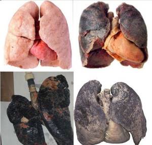 Smoker&#39;s lungs