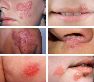 Localization of rashes