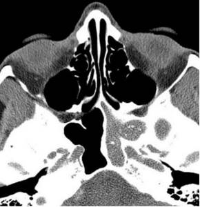 Magnetic tomography of the paranasal sinuses: left-sided sphenoiditis