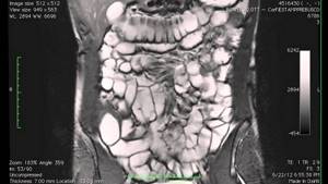 Magnetic resonance imaging of the intestine