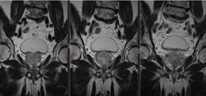 Magnetic resonance imaging of the prostate, photo in frontal projection
