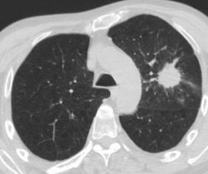 Metastatic lung disease