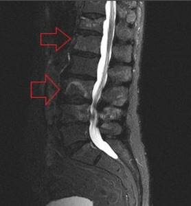 Metastases in the spine on MRI