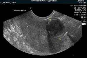 Uterine fibroids on ultrasound