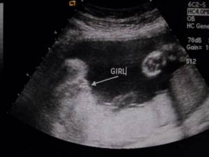Can an ultrasound be mistaken about the gender of the baby at 32 weeks?