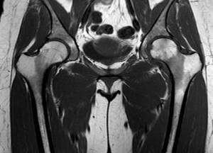 MRI scan of coxofemoral joints, normal variant