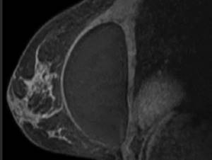 MRI image of the breast with an implant