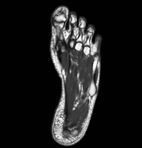 MRI image of the foot