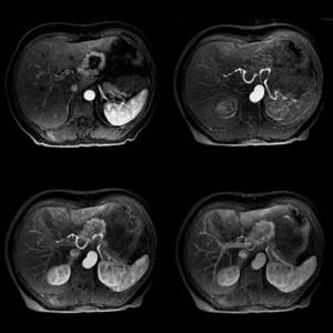 MRI of the abdomen with contrast