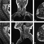 MRI of larynx and neck