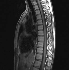 MRI of the thoracic spine
