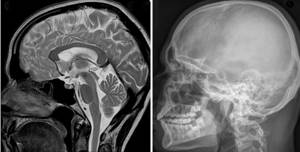 MRI and X-ray of the head