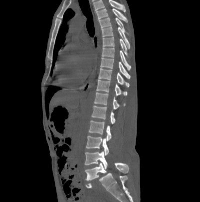 MRI or CT scan of the spine