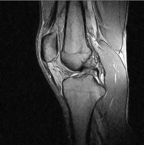 MRI of the knee joint (sagittal projection)